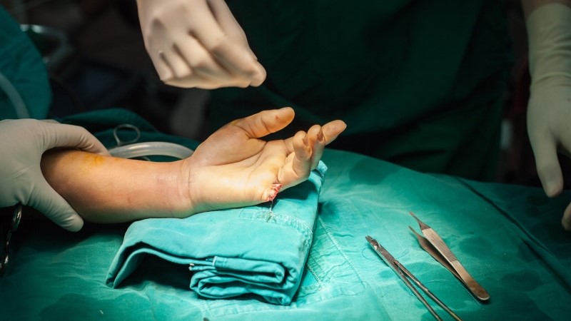 Amputation finger