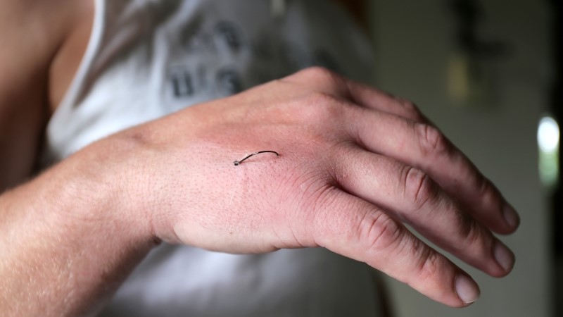 A man has been injured as a fish hook has punctured him and is still embedded in the skin of his hand.